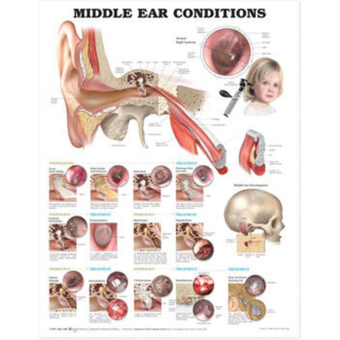 Chart of Middle Ear Conditions